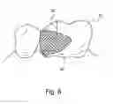 Fig. 07 - Matrix band