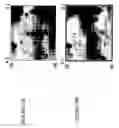 Fig. 13 - Focused microarray and methods of diagnosing chemotherapeutic drug resistance in a cancer cell
