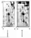 Fig. 53 - Focused microarray and methods of diagnosing chemotherapeutic drug resistance in a cancer cell