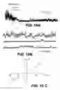 Fig. 14 - Methods for treating brain swelling with a compound that blocks a non-selective cation channel