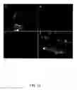 Fig. 40 - Methods for treating brain swelling with a compound that blocks a non-selective cation channel