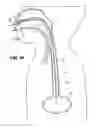 Fig. 27 - Methods and devices for non-invasive cerebral and systemic cooling