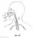 Fig. 37 - Methods and devices for non-invasive cerebral and systemic cooling