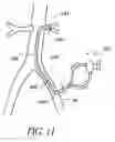 Fig. 12 - Cannulae having a redirecting tip