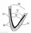 Fig. 01 - In-vivo method and device for improving diastolic function of the left ventricle