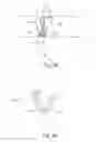 Fig. 03 - In-vivo method and device for improving diastolic function of the left ventricle