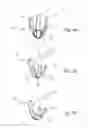 Fig. 05 - In-vivo method and device for improving diastolic function of the left ventricle