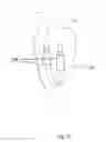 Fig. 17 - In-vivo method and device for improving diastolic function of the left ventricle