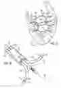 Fig. 05 - Device and method for treating congestive heart failure