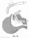 Fig. 22 - Luminous optical laryngoscope comprising built-in fluid-extraction device