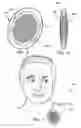 Fig. 04 - Method of preventing eye-related positional injuries during spinal surgery