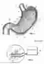 Fig. 02 - Method and device for treating obesity by suppressing appetite and hunger using vibration