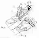 Fig. 02 - Low-profile, radial nerve splint with interchangeable resilient digit extensor elements and supination adjustment means