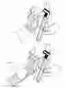 Fig. 05 - Low-profile, radial nerve splint with interchangeable resilient digit extensor elements and supination adjustment means
