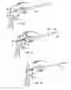 Fig. 04 - Lacrimal drainage bypass device and method