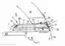 Fig. 01 - Glaucoma treatment device and method