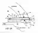 Fig. 04 - Glaucoma treatment device and method