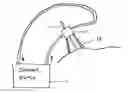 Fig. 01 - Cannula cooling and positioning device