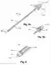Fig. 04 - Method and apparatus for implanting a hydrogel prosthesis for a nucleus pulposus