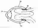 Fig. 01 - Methods and apparatus for excising tissue and creating wall-to-wall adhesions from within an organ