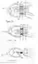 Fig. 04 - Methods and apparatus for excising tissue and creating wall-to-wall adhesions from within an organ