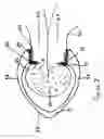 Fig. 07 - Methods and apparatus for excising tissue and creating wall-to-wall adhesions from within an organ