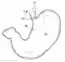 Fig. 01 - Dynamic reinforcement of the lower esophageal sphincter