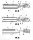 Fig. 04 - Stretch resistant embolic coil delivery system with mechanical release mechanism
