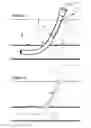 Fig. 02 - Hemostatic wire guided bandage and method of use