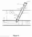 Fig. 04 - Vascular puncture sealing method, apparatus, and system