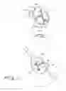 Fig. 09 - Septal defect closure device
