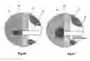 Fig. 06 - Methods and devices for treating dural puncture