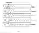 Fig. 05 - Method and apparatus for desynchronization of neural brain activity