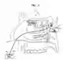 Fig. 03 - Method and apparatus for stimulating the sphenopalatine ganglion to modify properties of the BBB and cerebral blood flow