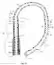 Fig. 11 - Coronary sinus lead for pacing the left atrium