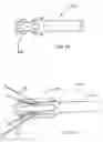 Fig. 10 - Methods of implanting a prosthesis and treating an aneurysm