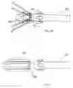 Fig. 11 - Methods of implanting a prosthesis and treating an aneurysm
