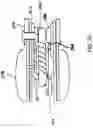 Fig. 12 - Methods of implanting a prosthesis and treating an aneurysm