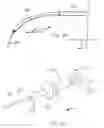 Fig. 23 - Methods of implanting a prosthesis and treating an aneurysm