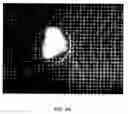 Fig. 25 - Methods of implanting a prosthesis and treating an aneurysm