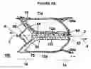 Fig. 07 - Medical device including remodelable material attached to frame