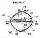 Fig. 09 - Medical device including remodelable material attached to frame