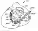 Fig. 01 - Mitral valve annuloplasty device with twisted anchor