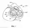 Fig. 02 - Mitral valve annuloplasty device with twisted anchor