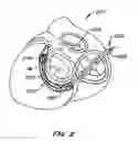 Fig. 03 - Mitral valve annuloplasty device with twisted anchor