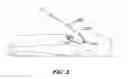 Fig. 04 - Mitral valve annuloplasty device with twisted anchor