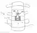 Fig. 01 - Implant for stabilizing a bone graft during spinal fusion