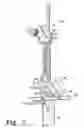 Fig. 06 - Procedure for the treatment of cuff tear arthropathy
