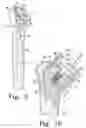 Fig. 08 - Procedure for the treatment of cuff tear arthropathy