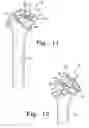 Fig. 09 - Procedure for the treatment of cuff tear arthropathy